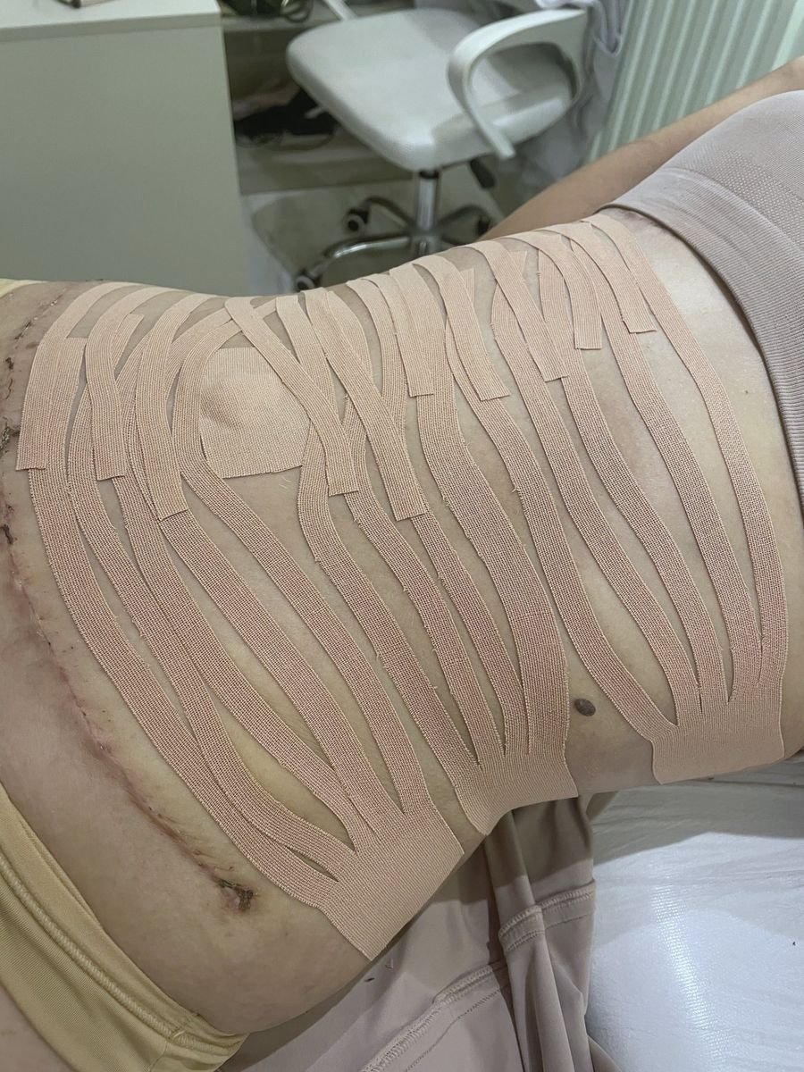 Taping terapêutico aplicado no abdômen durante o pós-operatório